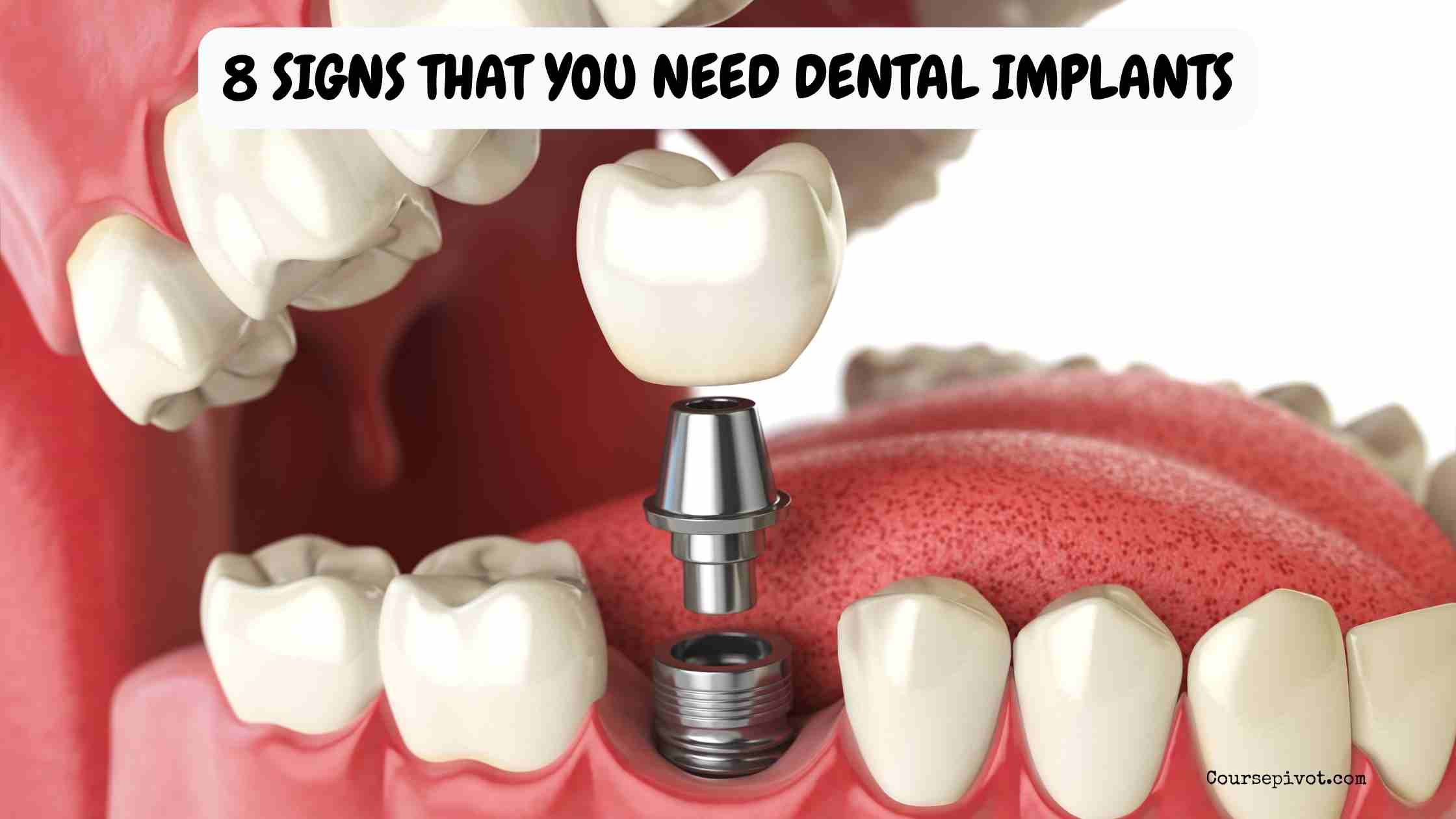8 Signs That You Need Dental Implants